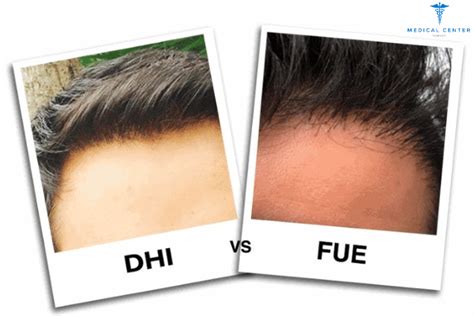 DHI Methode Vs. FUE: Wat Is Beter?