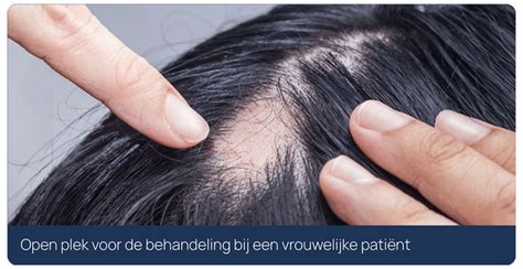 Haartransplantatie Behandeling Voor Vrouwen