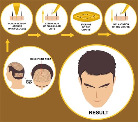 Haartransplantatie En Psychologie: Hoe Het Uw Zelfbeeld Beïnvloedt