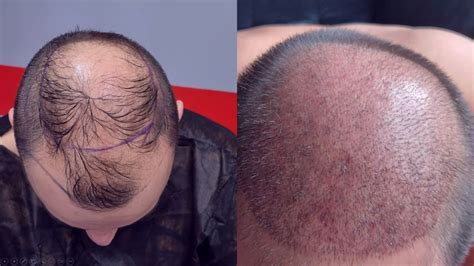 Hoe Herstel Je Van Een Haartransplantatie?