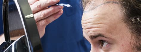 Wat U Moet Weten Voor Uw Eerste Haartransplantatie Consult