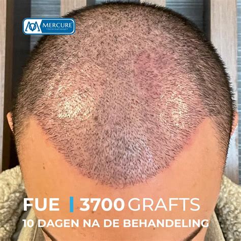 Haartransplantatie Saffier FUE: De Minste Invasieve Optie