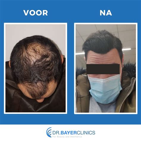 Preventie Van Haarverlies: Voor En Na Haartransplantatie