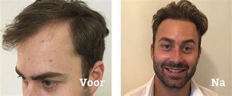 Voorkomen Van Haaruitval Na Haartransplantatie