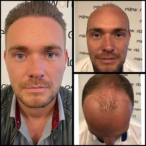 Haartransplantatie Beoordelingen: Kies De Beste Behandeling