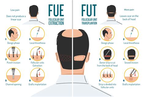 Haartransplantatie Vergelijking: FUE Vs. FUT