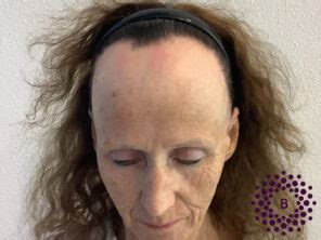 Haartransplantatie Voor Mensen Met Alopecia