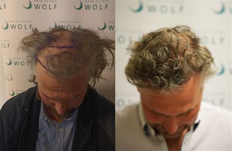 Een Goedkope Haartransplantatie: Is Het Het Waard?