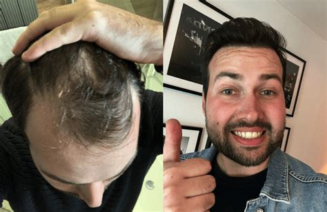 Haartransplantatie En Haarverlies Door Medicatie