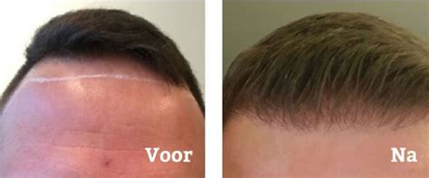 Haartransplantatie: Hoe Werkt De Consultatie?