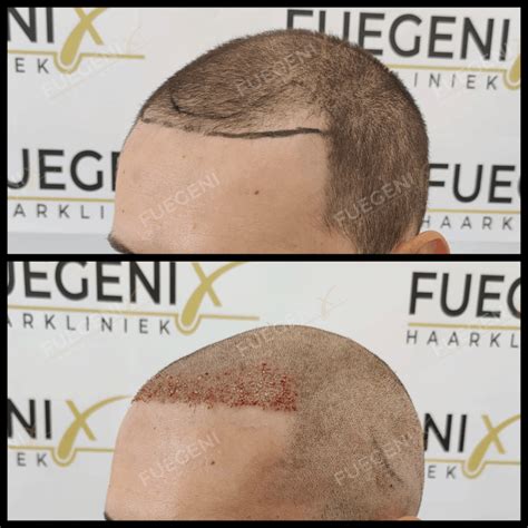 Hoe Haartransplantatie Kan Helpen Bij Alopecia