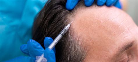 Hoe PRP Werkt Voor Haartransplantatie