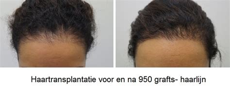 De Impact Van Haartransplantatie Op Je Zelfvertrouwen