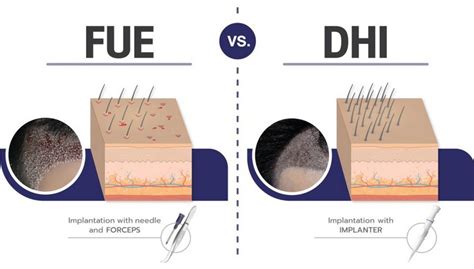 DHI Vs. FUE: Welke Haartransplantatie Methode Is Beter?