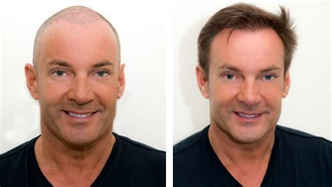 Hoe Te Herstellen Van Een Haartransplantatie?