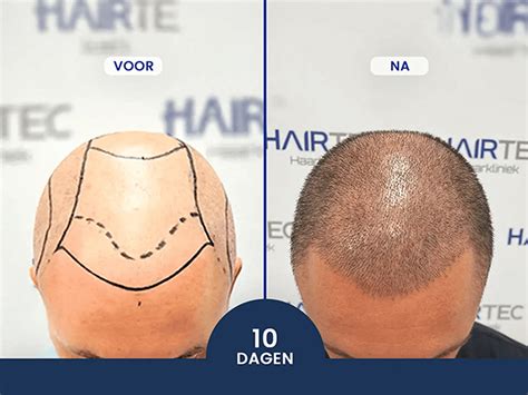 Wat Is De DHI Haartransplantatie Techniek?